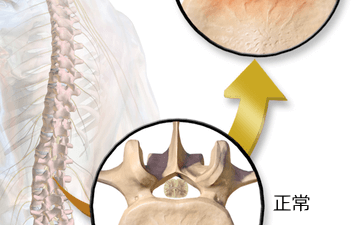 脊柱管狭窄症と腰痛