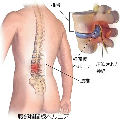 札幌腰痛整体 腰椎椎間板ヘルニア画像