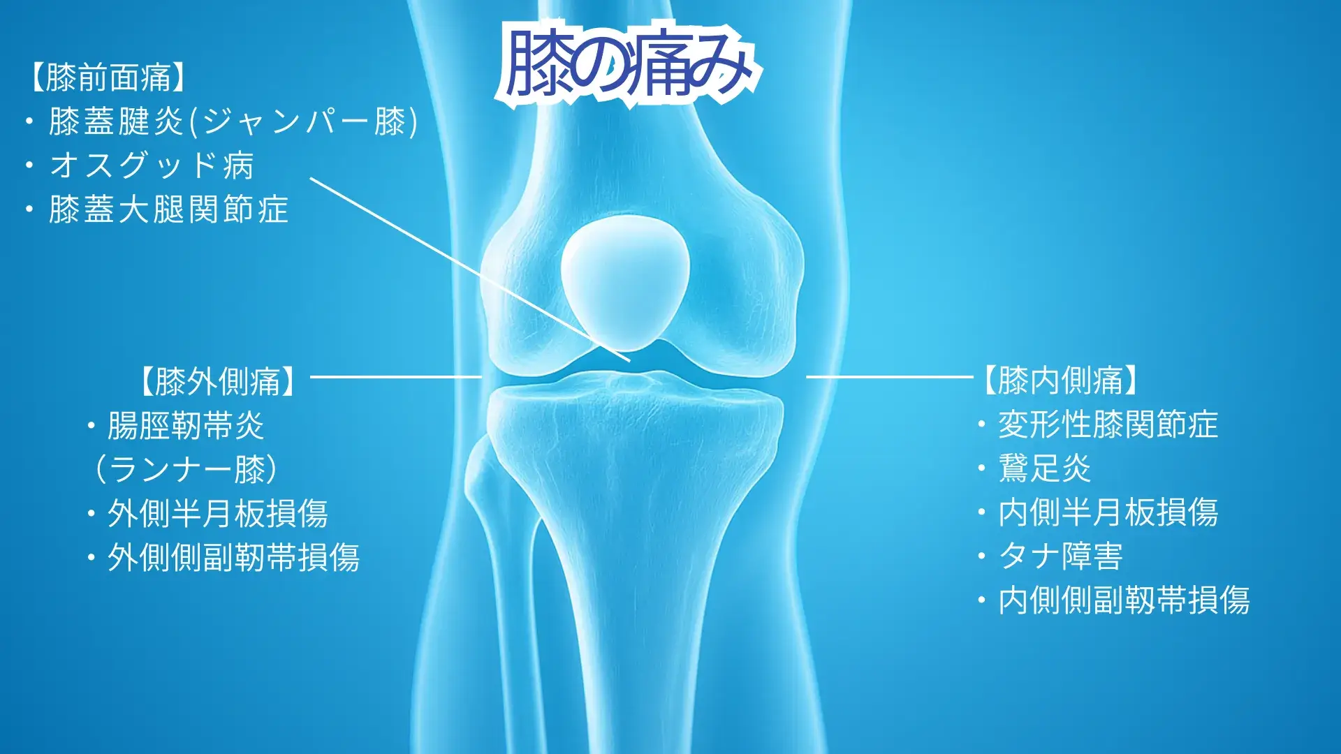 膝の痛みマップ(膝内側痛、膝外側痛、膝前面痛)